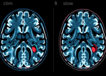 AI Reads Carotid Scans to Predict Which Plaques Will Cause Strokes