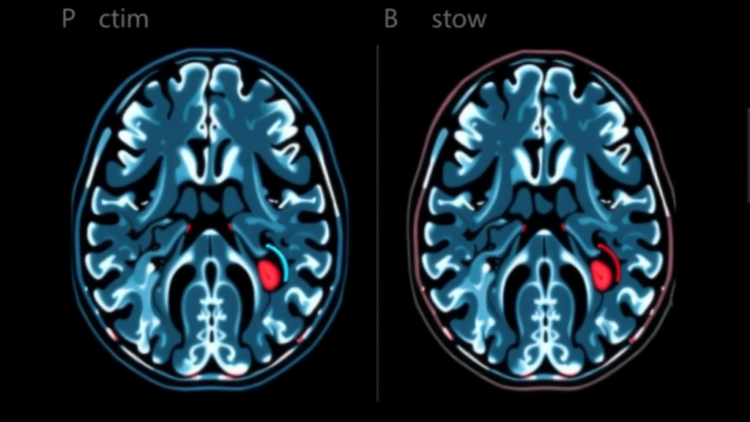 AI Reads Carotid Scans to Predict Which Plaques Will Cause Strokes