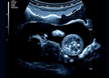 AI System Brings Standardized Cystocele Diagnosis to Dynamic Pelvic Ultrasound