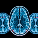 Lightweight AI Network Reads Brain Scans to Spot Alzheimer’s and Tumors With Striking Accuracy