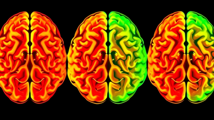 Brain-Wide Activity Ties Subcortical Decline to Spreading Tau in Early Alzheimer’s