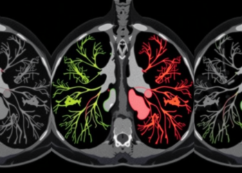 Hybrid AI Model Spots Lung Cancer Subtypes on CT Scans With 92% Accuracy