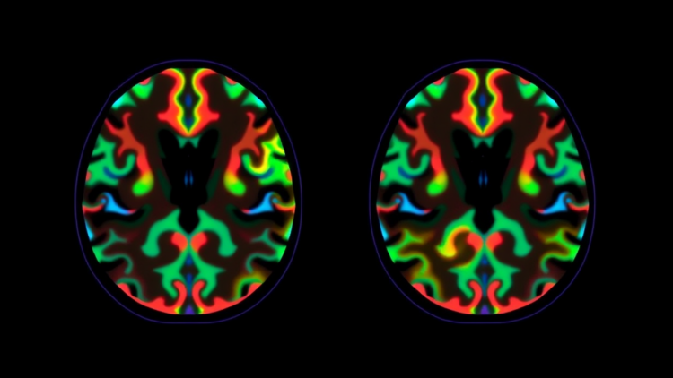 APOE4 Splits Alzheimer’s Into Two Neurochemical Diseases, PET Imaging Study Reveals
