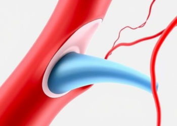 New Math Model Reveals How Rough, Misaligned Artery Walls Aggravate Blood Flow