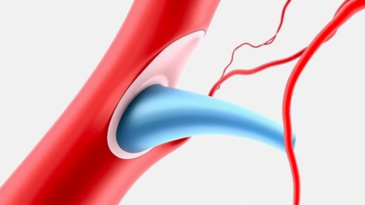 New Math Model Reveals How Rough, Misaligned Artery Walls Aggravate Blood Flow