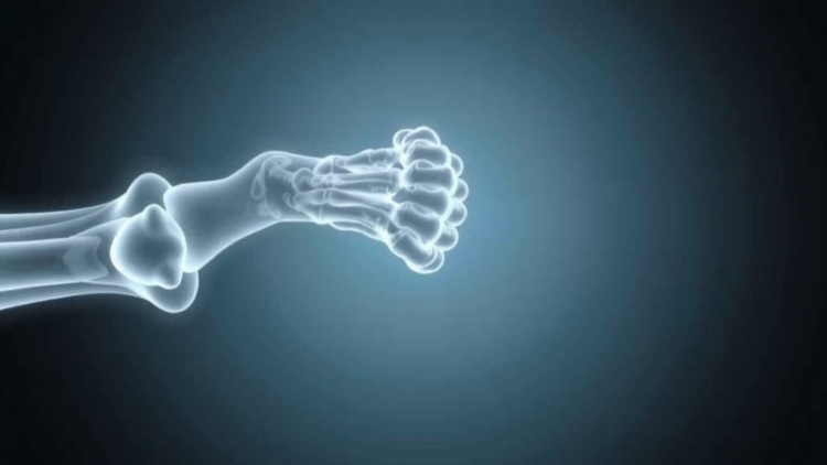 Soy Compound Genistein Shows Promise Against Diabetes-Linked Bone Loss
