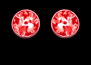 Timing Matters: Radiotherapy Within Six Weeks Reshapes Outcomes After Incomplete Spinal Ependymoma Surgery
