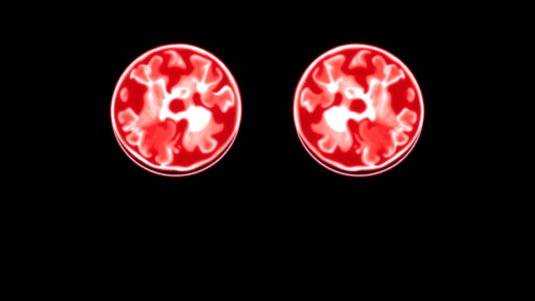 Timing Matters: Radiotherapy Within Six Weeks Reshapes Outcomes After Incomplete Spinal Ependymoma Surgery