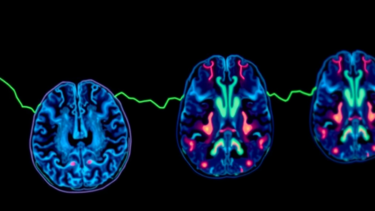 Lost Epigenetic Guardian CBX7 Emerges as Key Driver and Drug Target in Glioblastoma