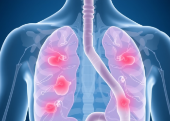 More Removed Lymph Nodes Linked to Worse Outcomes After Immunotherapy in Colorectal Cancer