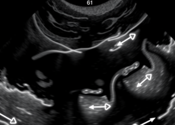 Ultrasound Right After Childhood Kidney Biopsy Predicts Dangerous Bleeding, Study Finds