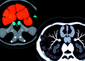 AI Reads Body Fat on CT Scans to Predict Sepsis Survival