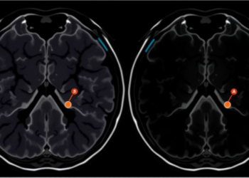 Two PSMA PET Tracers Match Each Other and Outperform MRI in Detecting Prostate Tumours