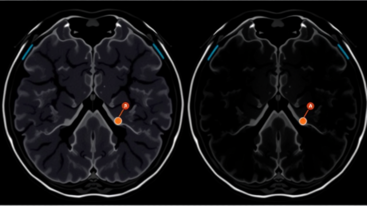 Two PSMA PET Tracers Match Each Other and Outperform MRI in Detecting Prostate Tumours