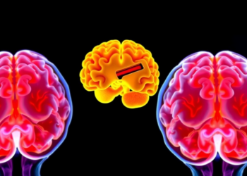 Alzheimer’s Disease Beyond Amyloid: What Atherosclerosis Teaches Us About Dementia Risk