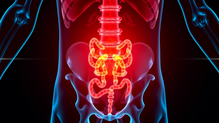 Chemoradiotherapy May Unlock Immunotherapy in Hard-to-Treat Rectal Cancer