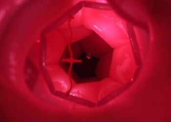Colonoscopy Reveals Hidden Causes of Childhood Intussusception