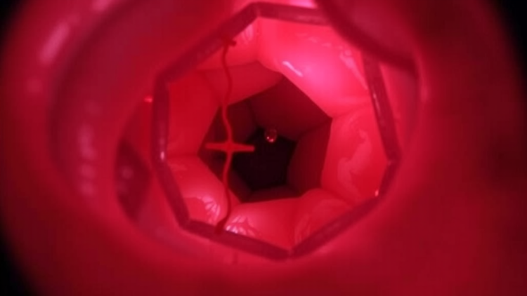 Colonoscopy Reveals Hidden Causes of Childhood Intussusception