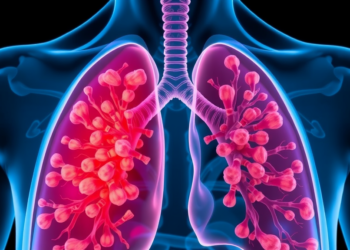 Achalasia Treatment Alone Clears Rare Mycobacterial Lung Infection in a World First