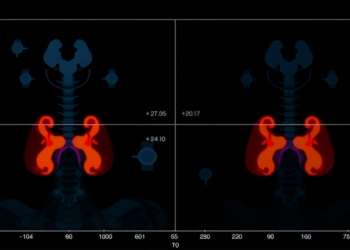 New Nomogram Predicts Which Thyroid Cancer Patients Will Fail Radioactive Iodine Therapy