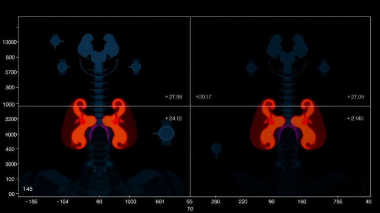 New Nomogram Predicts Which Thyroid Cancer Patients Will Fail Radioactive Iodine Therapy