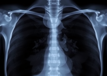 Ovarian Cancer Returns as a Rare Breast Tumor in a Puzzling Case