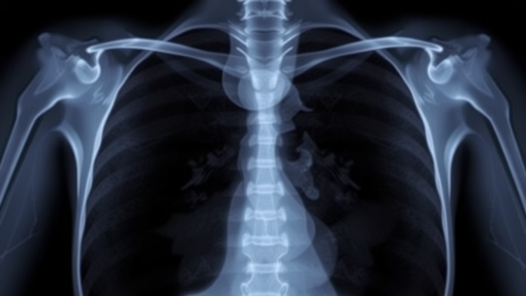 Ovarian Cancer Returns as a Rare Breast Tumor in a Puzzling Case