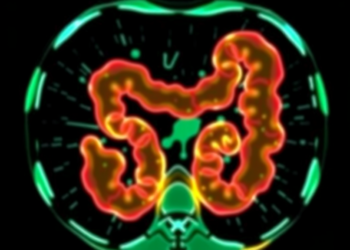 Spectral CT and AI Join Forces to Predict Aggressive Bowel Cancer Before Surgery