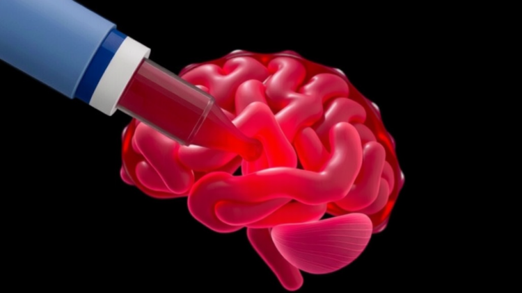Simple Blood Clot Marker and AI Models Predict Recovery After Brain Bleed