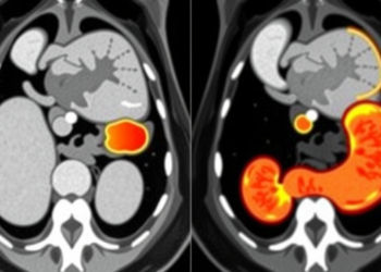 AI Model Spots Muscle-Wasting Syndrome in Gastric Cancer Patients from Routine CT Scans