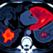 New PET Tracer Outshines Standard FDG Scan in Spotting Cancer Spread to the Liver