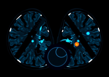 AI Turns Lymphoma PET/CT Scans Into Automated Diagnosis and Survival Forecasts