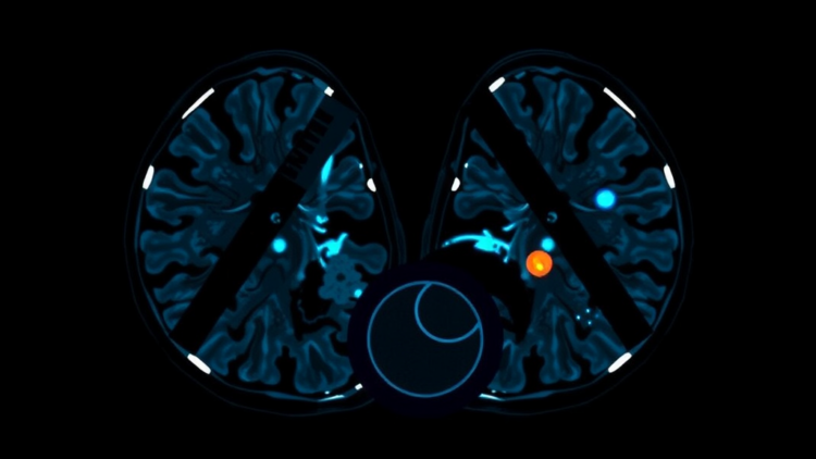 AI Turns Lymphoma PET/CT Scans Into Automated Diagnosis and Survival Forecasts