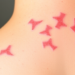 Vitamin D Compound Tames Psoriasis by Switching Off a Hidden Inflammatory Gene