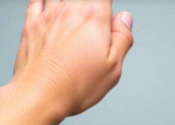 Two Immune Drugs Combined Achieve Dramatic Recovery in Stubborn Psoriatic Arthritis Case