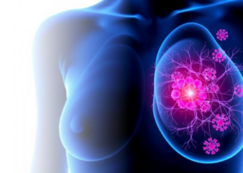 Immune Cells Inside Breast Tumours May Signal Spread to Lymph Nodes