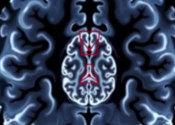 One MRI Sign Predicts Which Slow-Growing Brain Tumors Will Turn Deadly