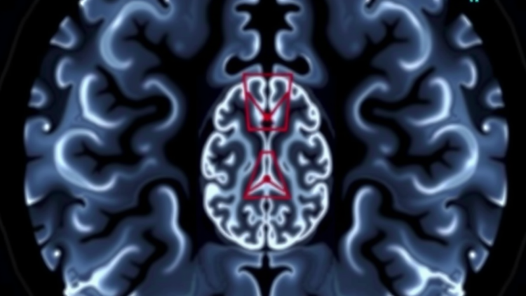 One MRI Sign Predicts Which Slow-Growing Brain Tumors Will Turn Deadly
