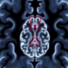 One MRI Sign Predicts Which Slow-Growing Brain Tumors Will Turn Deadly