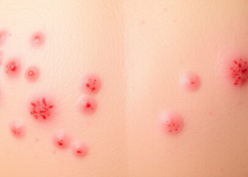 Inflammatory Skin Disorders Found More Common in Women with Polycystic Ovary Syndrome