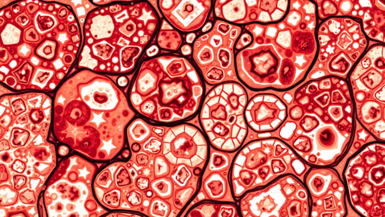 Tumor Slice Cultures Reveal New Pitfalls in Testing AAV Gene Therapy for Glioblastoma