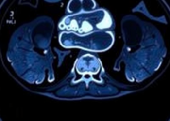 Rare Arterial Injury After Yttrium-90 Radioembolization Reveals Hidden Vascular Risk