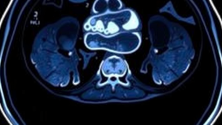 Rare Arterial Injury After Yttrium-90 Radioembolization Reveals Hidden Vascular Risk