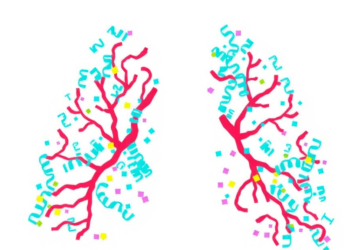 Genomic and Transcriptomic Landscape of Spread Through Air Spaces in Stage 1 Lung Adenocarcinoma