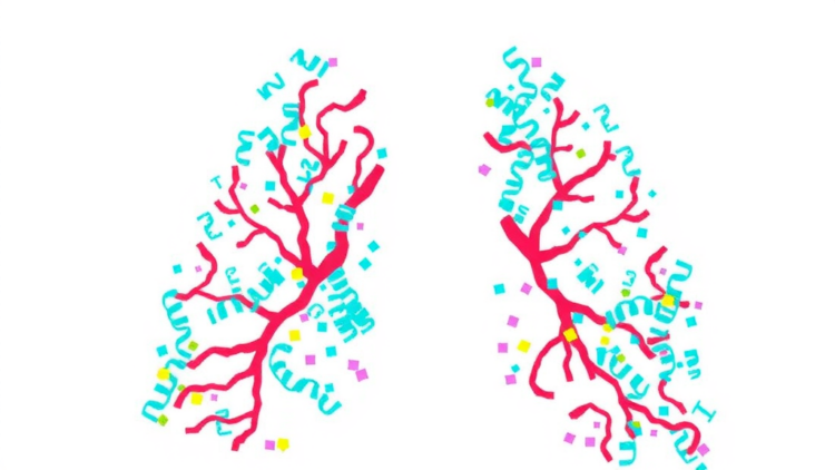 Genomic and Transcriptomic Landscape of Spread Through Air Spaces in Stage 1 Lung Adenocarcinoma