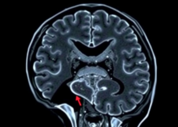 Mysterious Claustrum Sign on MRI May Track a Devastating Epileptic Emergency