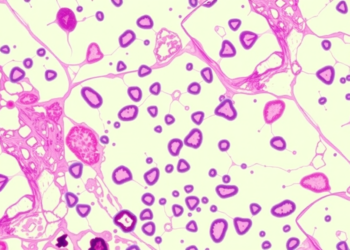 Graph neural networks teach AI to read breast cancer slides like pathologists