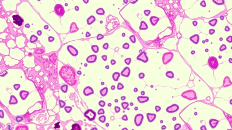 Graph neural networks teach AI to read breast cancer slides like pathologists