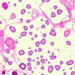 Graph neural networks teach AI to read breast cancer slides like pathologists