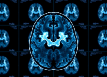 SPECT Rivals PET in Head-to-Head Test of Parkinson’s Brain Scans